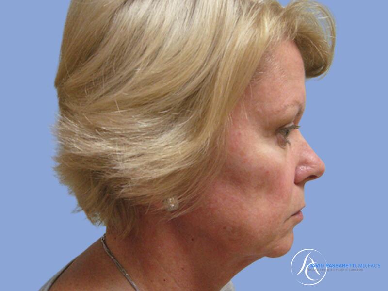 Facelift before & after photo