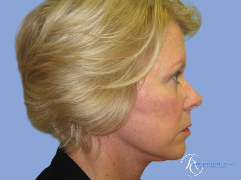 Facelift before & after photo