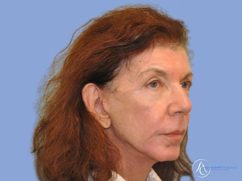 Facelift before & after photo