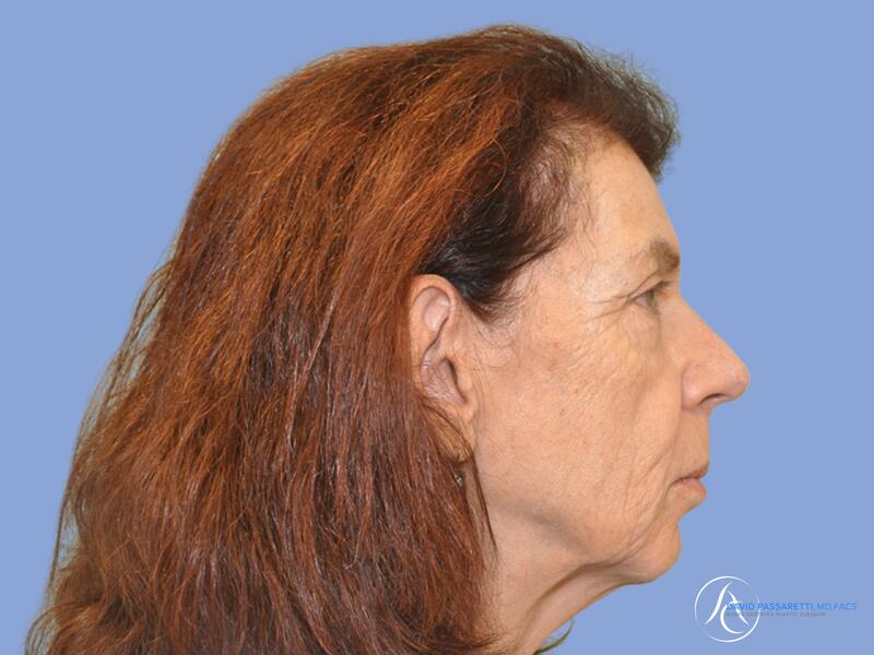 Facelift before & after photo