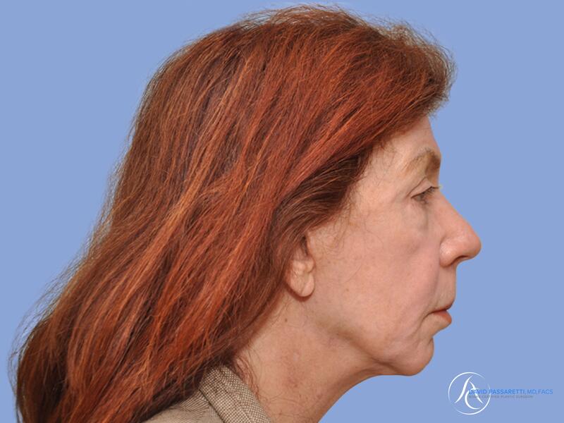 Facelift before & after photo