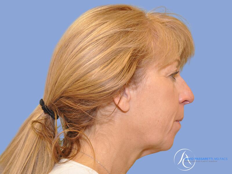 Neck lift before & after photo