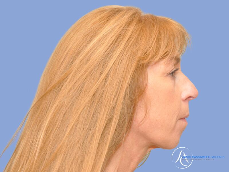 Neck lift before & after photo