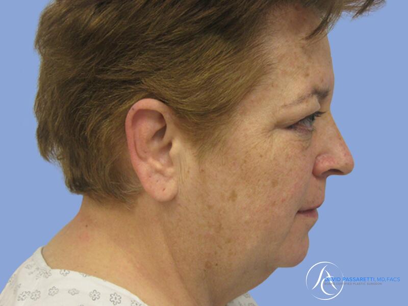 Neck lift before & after photo