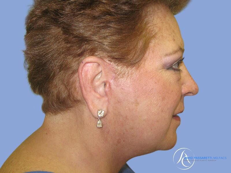 Neck lift before & after photo