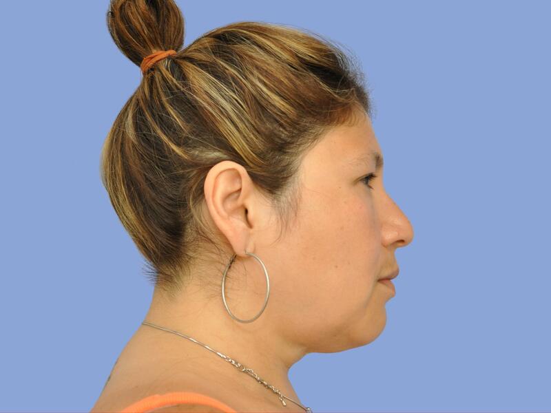 Neck lift before & after photo