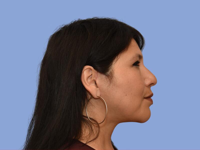 Neck lift before & after photo