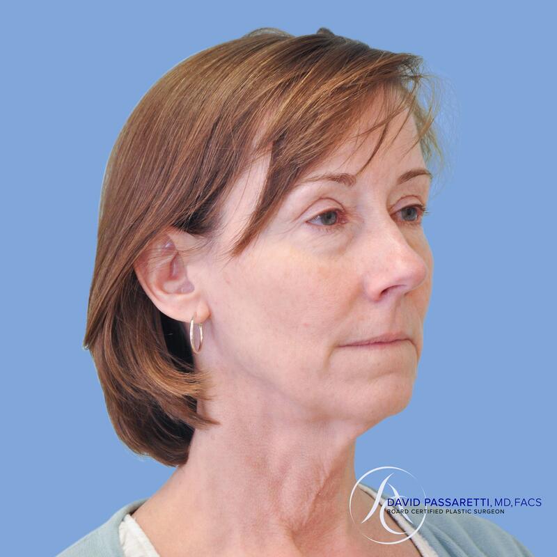 Neck lift before & after photo