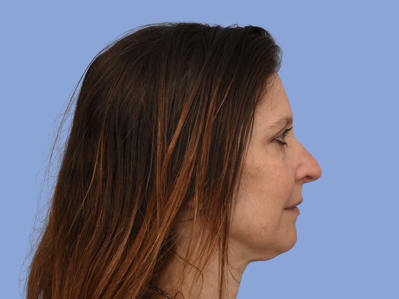 Neck lift before & after photo