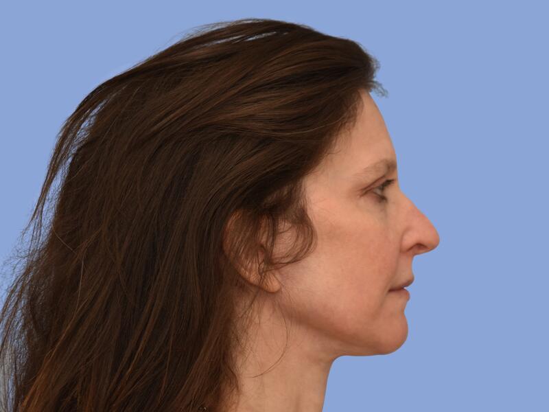 Neck lift before & after photo