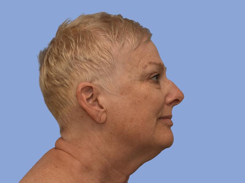 Neck lift before & after photo