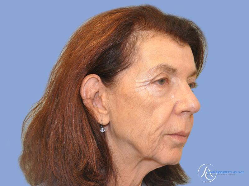 Neck lift before & after photo