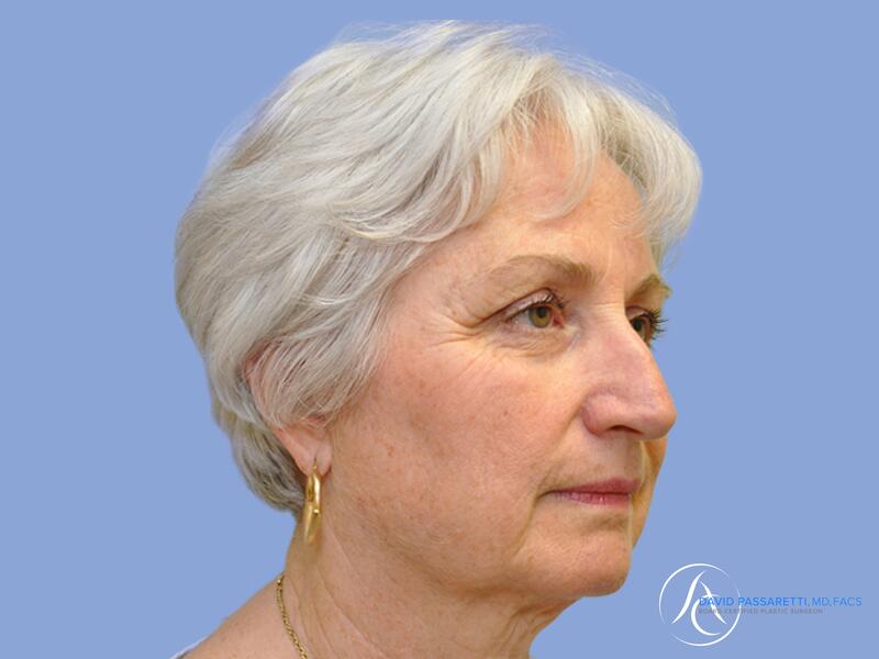 Neck lift before & after photo