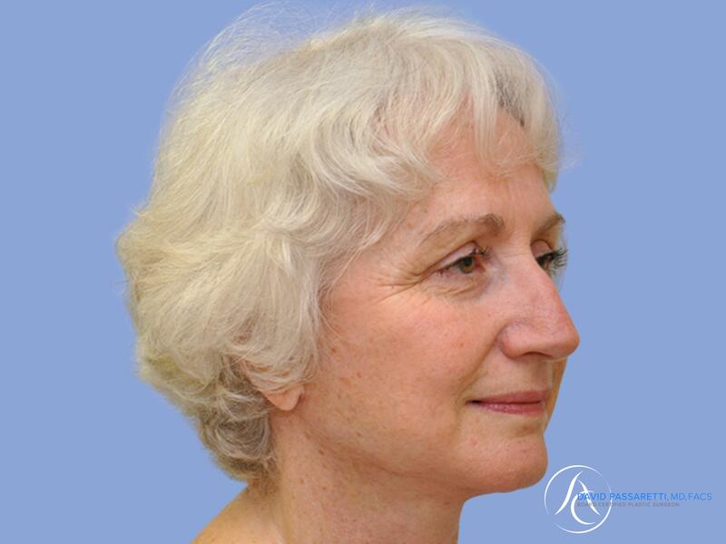 Neck lift before & after photo