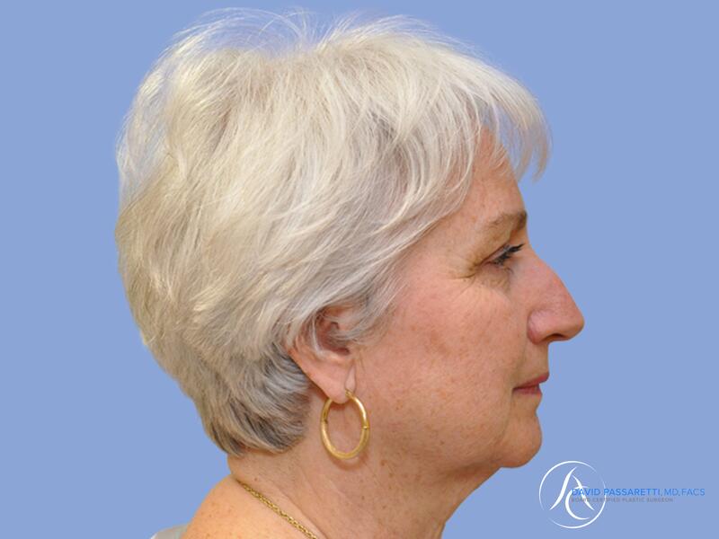 Neck lift before & after photo