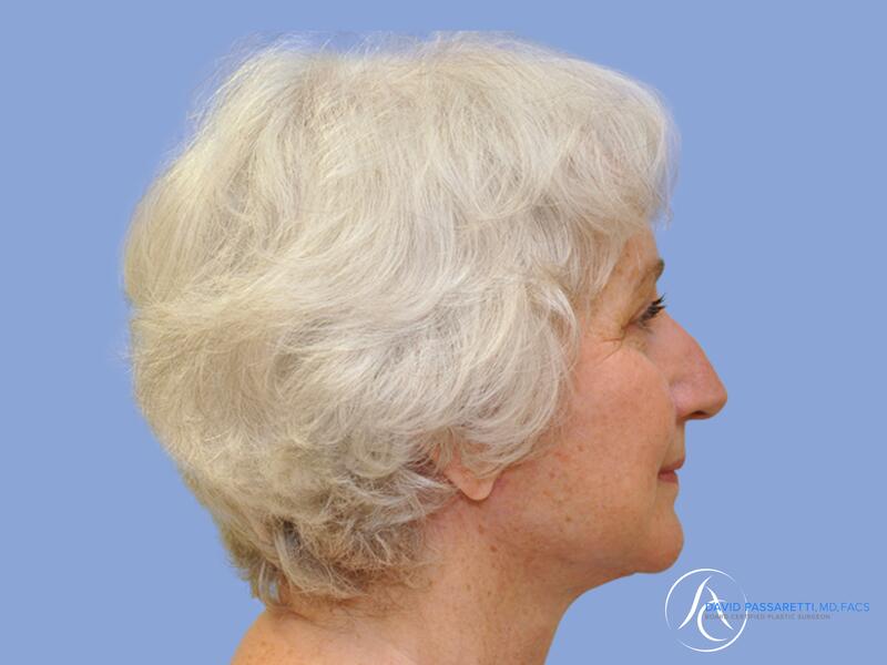 Neck lift before & after photo