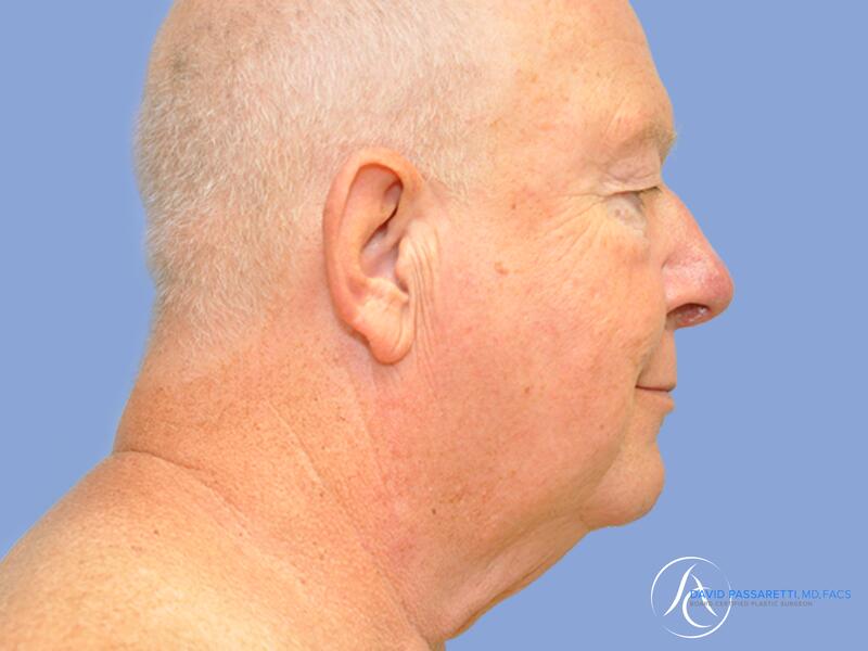 Neck lift before & after photo