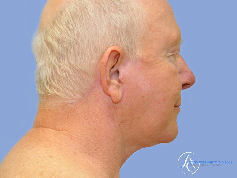 Neck lift before & after photo