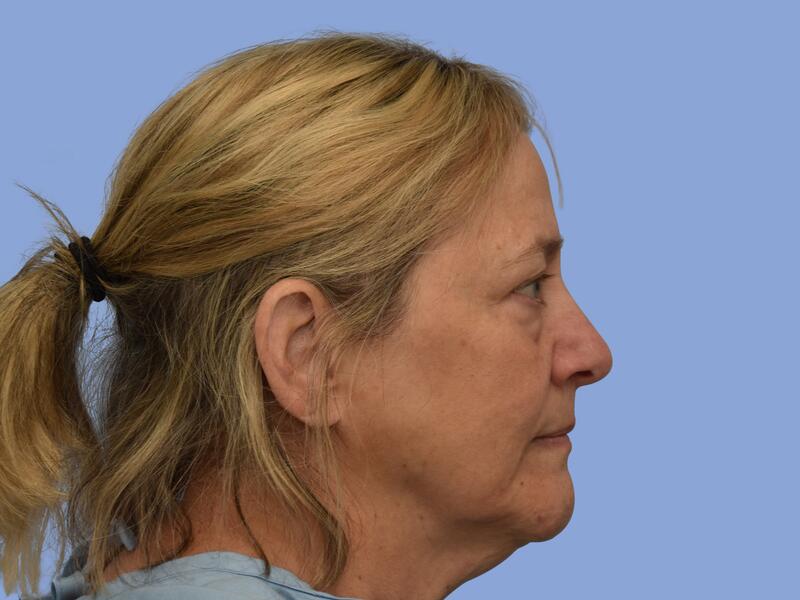 Neck lift before & after photo