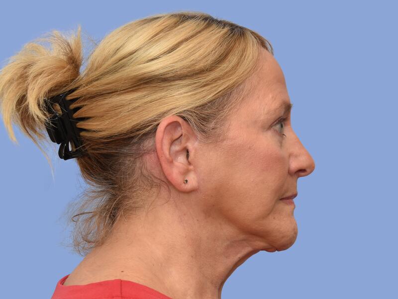 Neck lift before & after photo