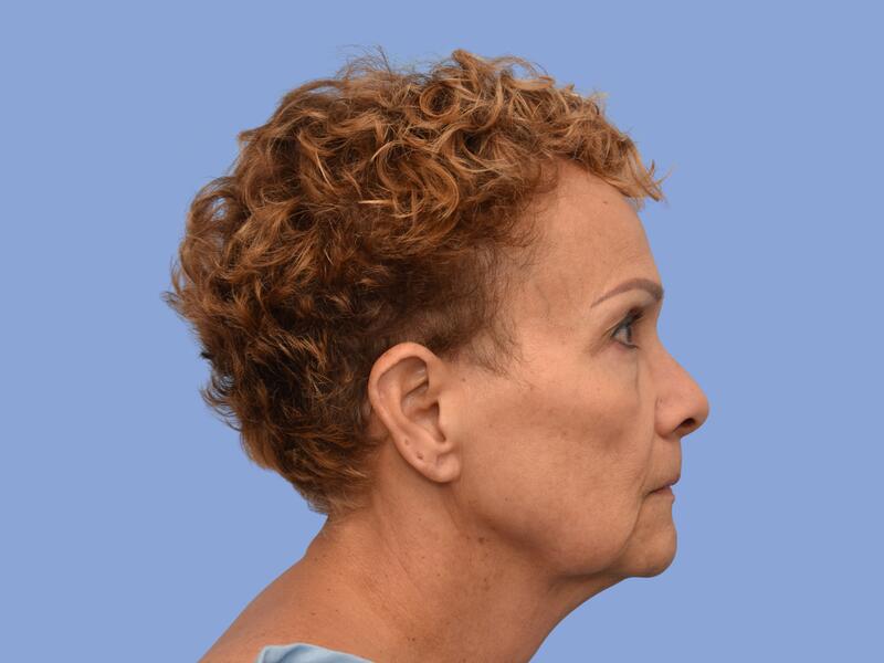 Neck lift before & after photo