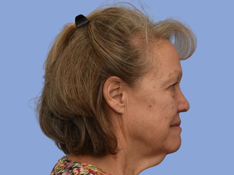 Neck lift before & after photo