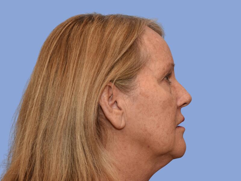 Neck lift before & after photo