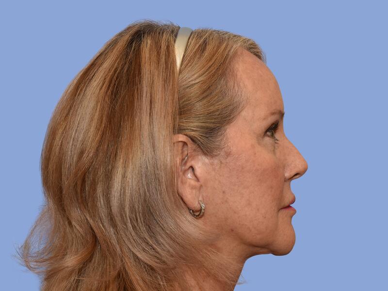 Neck lift before & after photo