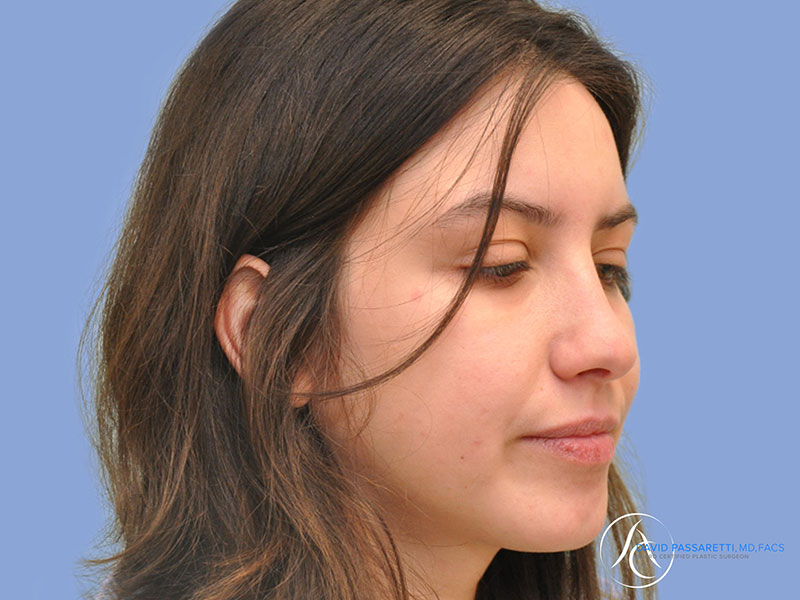 Rhinoplasty before & after photo