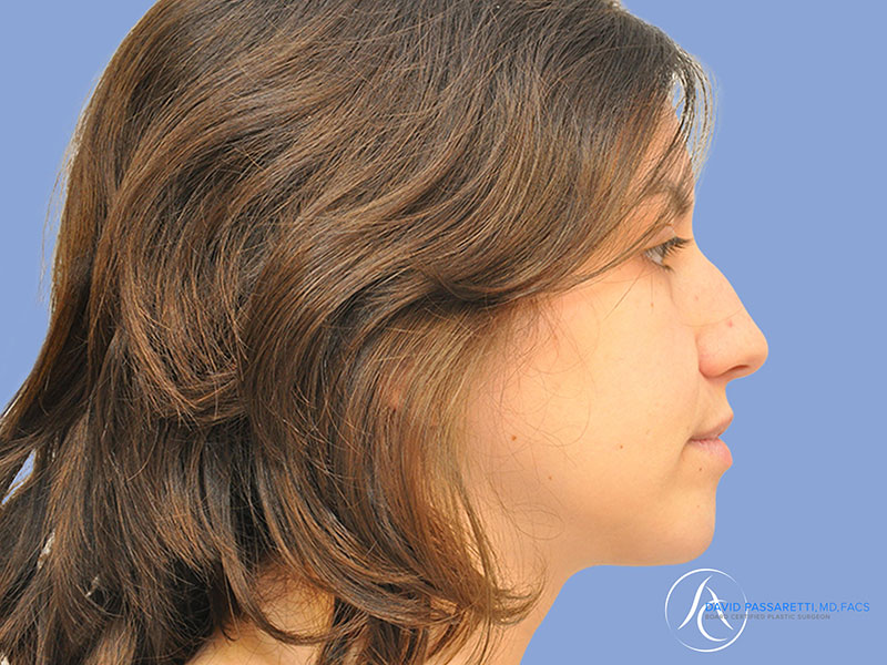 Rhinoplasty before & after photo