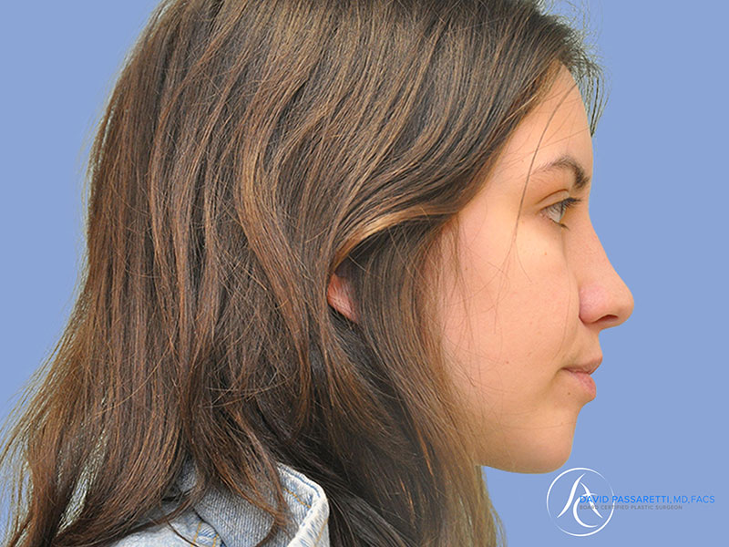 Rhinoplasty before & after photo