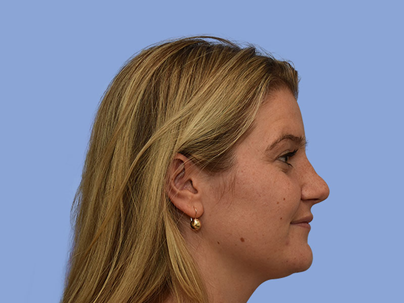 Rhinoplasty before & after photo