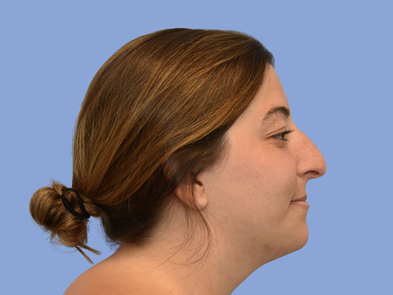 Rhinoplasty before & after photo