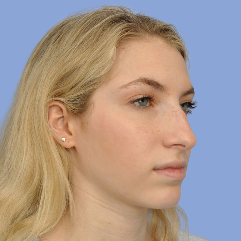 Rhinoplasty before & after photo