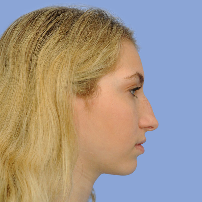 Rhinoplasty before & after photo