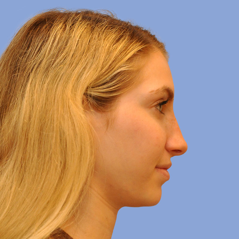 Rhinoplasty before & after photo