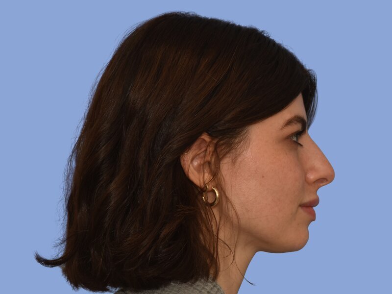 Rhinoplasty before & after photo